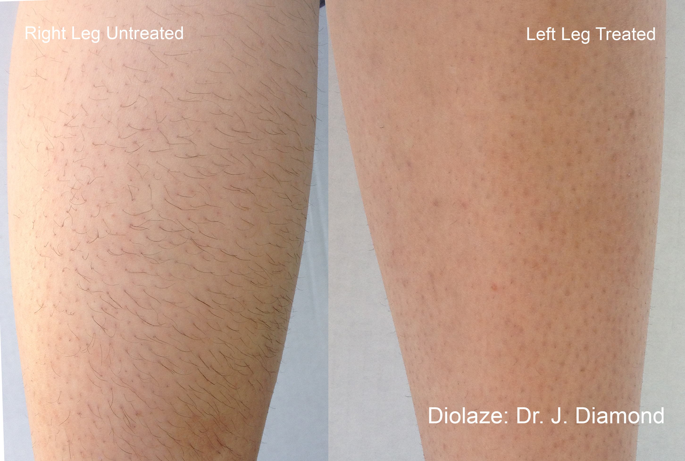 Diolaze laser hair removal &mdash; treated vs untreated