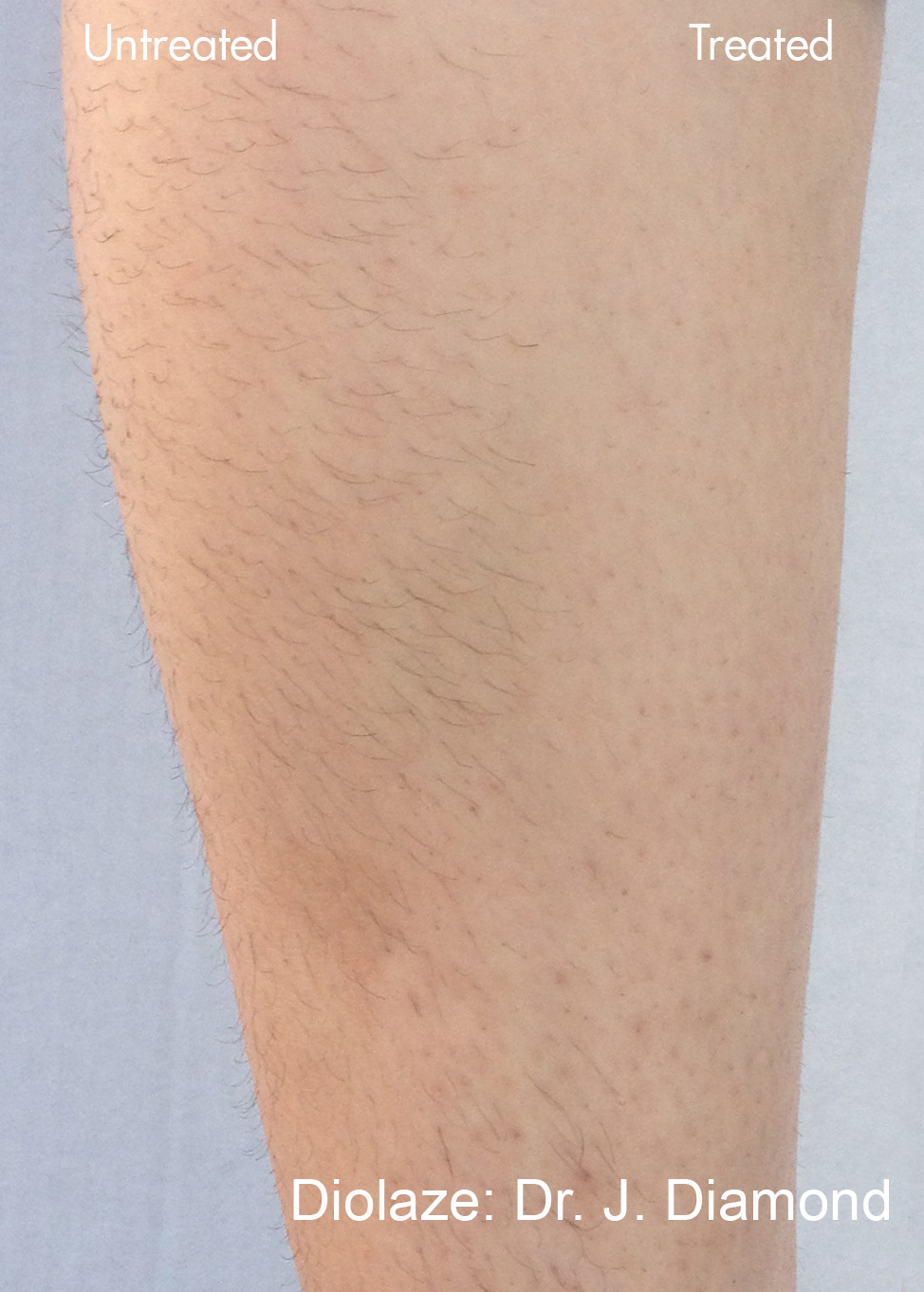 Diolaze laser hair removal before and after close-up &mdash; reduced hair density on treated skin