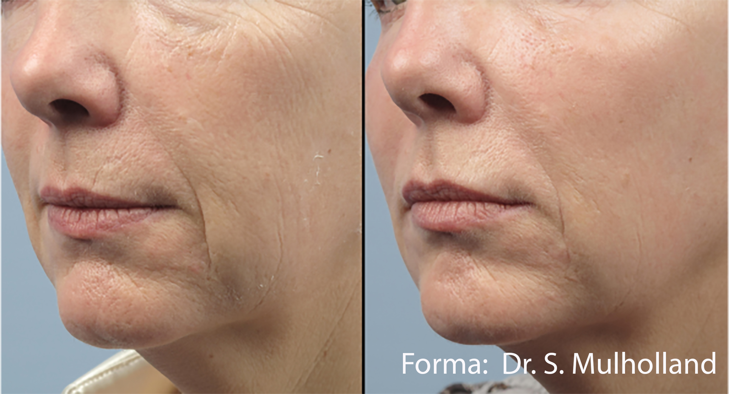 Forma RF skin tightening &mdash; before and after