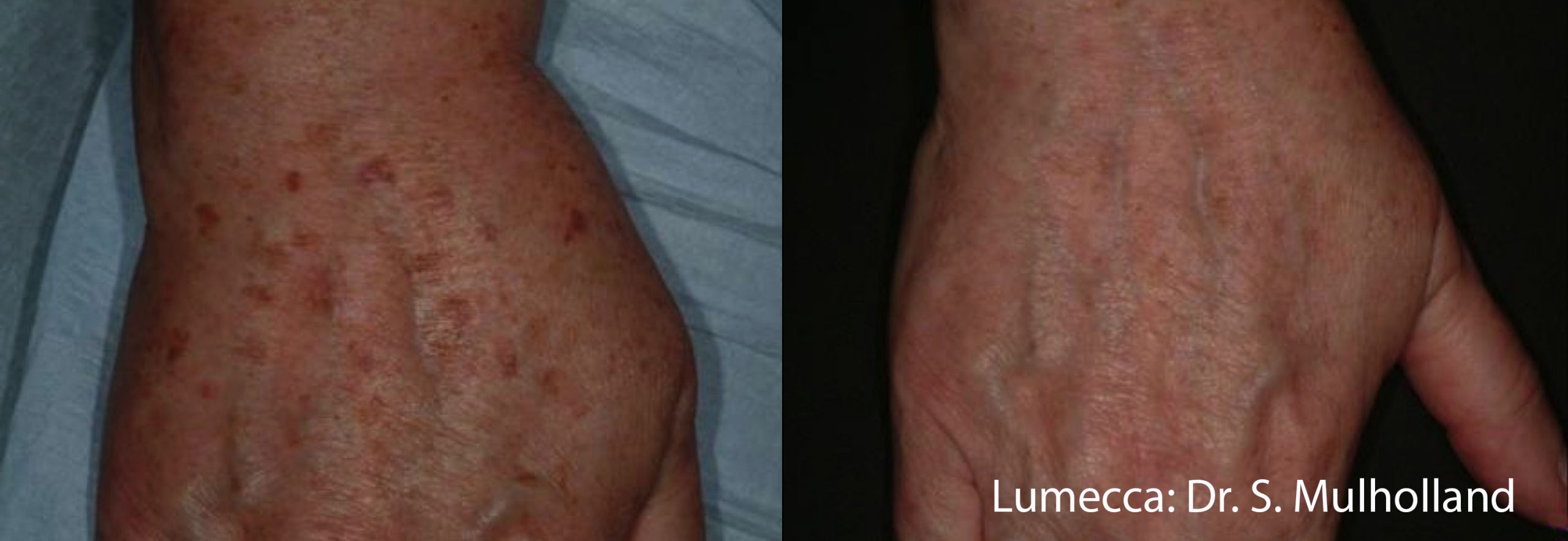 Lumecca IPL photofacial &mdash; before and after