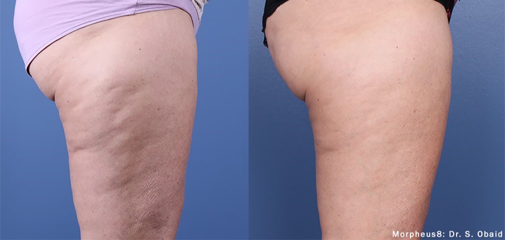 Morpheus8 body treatment baseline