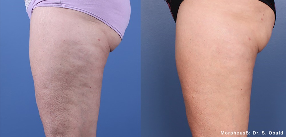 Morpheus8 body treatment results