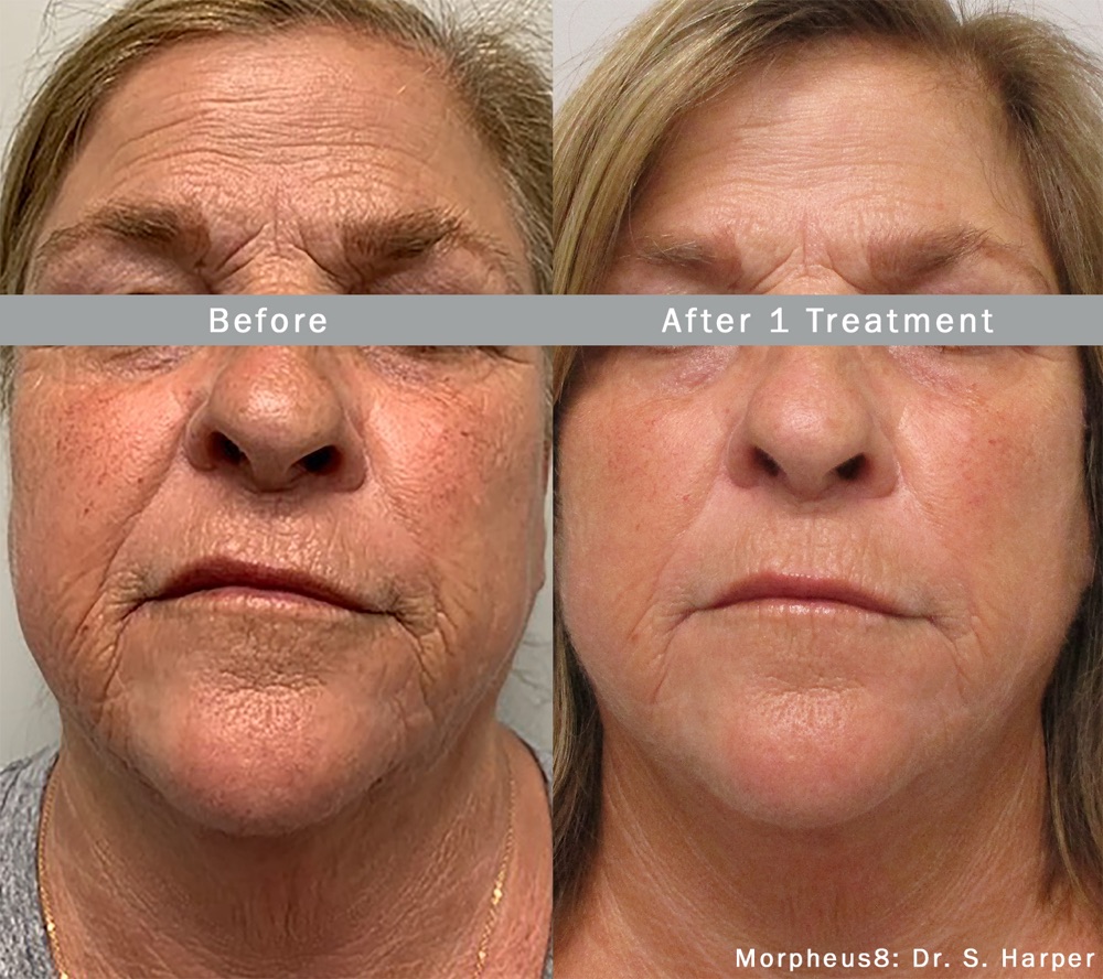 Morpheus8 RF microneedling