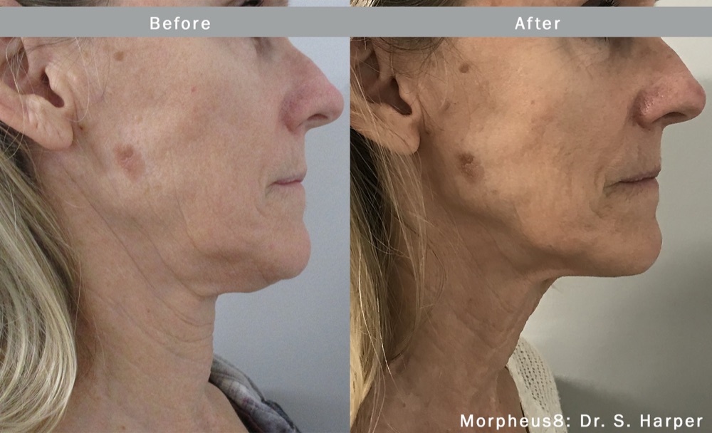 Morpheus8 periorbital treatment