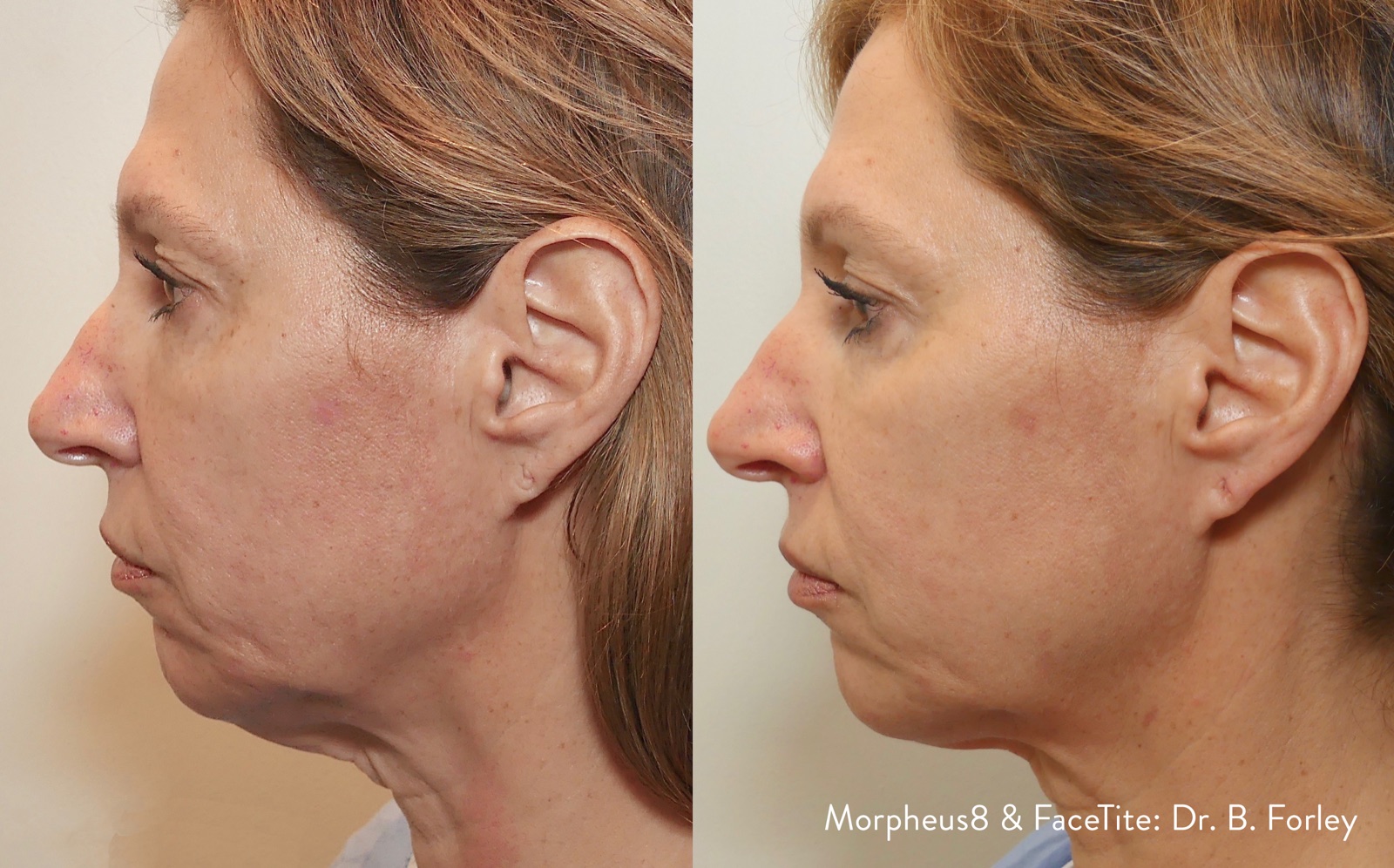 Morpheus8 face and neck before and after